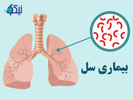 علائم بيماري سل چيست؟(راه پيشگيري از سل چيست؟)