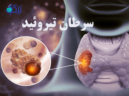 سرطان تیروئید را چگونه میتوان در آزمایشگاه نیکو تشخیص داد؟