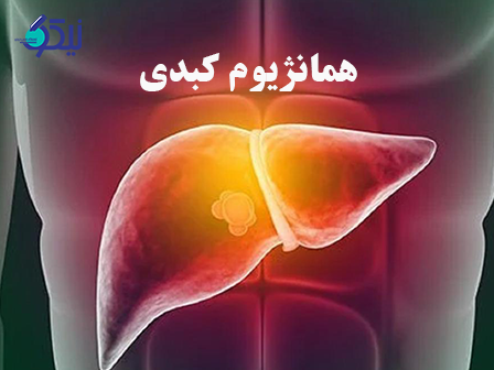 همانژیوم کبدی چگونه درمان می شود؟