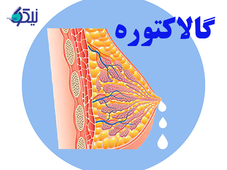 گالاکتوره چيست؟ چگونه گالاکتوره را درمان کنیم؟