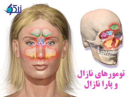 تومورهای نازال و پارانازال ; علائم و طول عمر سرطان بینی