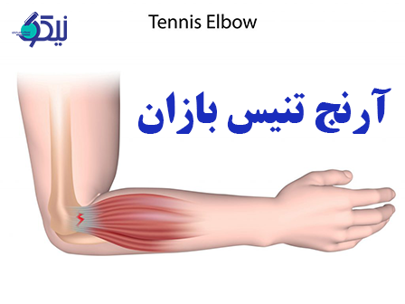 بیماری آرنج تنیس بازان چه علائمی ایجاد میکند؟