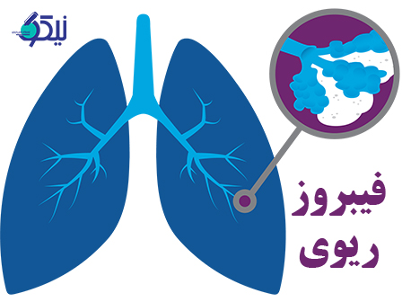 فیبروز ریوی ایدیوپاتیک (IPF) چیست؟