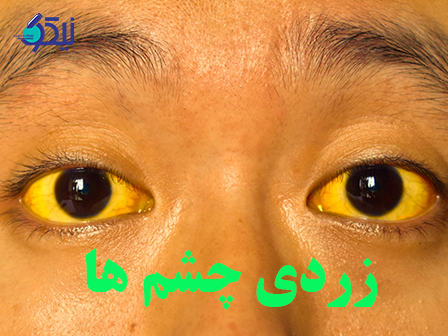 چه عواملی باعث زردی چشم ها میشود؟
