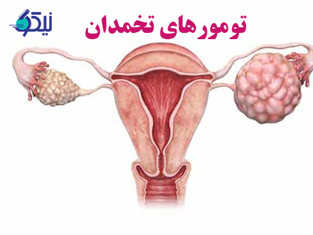 توده تخمدان چیست؟