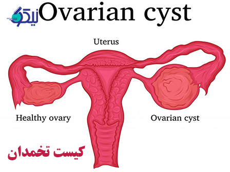 کیست تخمدان چیست؟ روش‌های پیشگیری و درمان