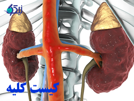 کیست های کلیه چگونه درمان می شوند؟ (درمان فوری کیست کلیه)