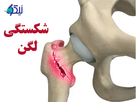 آیا شکستگی لگن قابل درمان است؟