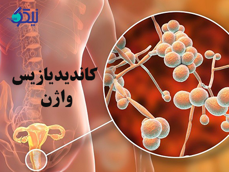 عفونت قارچی کاندیدیازیس واژن و درمان آن