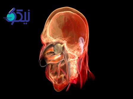 راهنمای کامل نوروبلاستوما بویایی ; علت، تشخیص و درمان