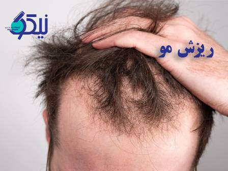 ریزش مو اتفاقی نیست؛ نگاهی علمی و ساده به دلایل اصلی