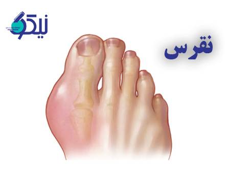 نقرس؛ علائم، تشخیص و عوامل خطر 