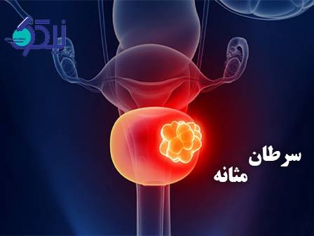 سرطان مثانه؛ یک علامت، هزاران پیام!
