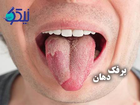 برفک دهان؛ از شناخت تا درمان مؤثر