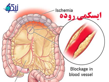 علل ایجاد ایسکمی روده و علائم تشخیص این بیماری چیست؟