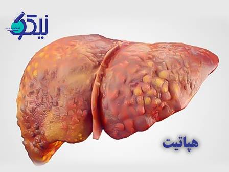 هپاتیت B و C؛ تفاوت در علائم، مسیر انتقال و نتایج آزمایشگاهی