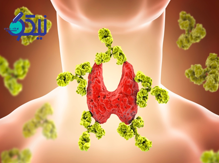 علائم بیماری تیروئیدیت هاشیموتو و روش های تخشیص و درمان آن