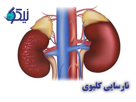 نارسایی کلیوی چیست؟ 