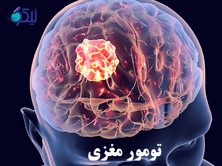 تومور های مغزی چه علائمی ایجاد می کنند؟