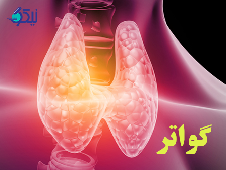 گواتر چیست؟ علائم، تشخیص و درمان گواتر