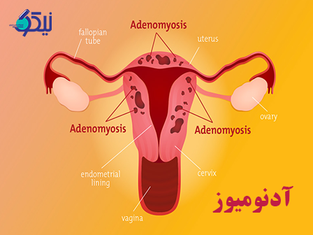 آدنومیوز چیست؟