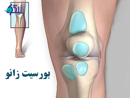 بورسیت چیست؟ راه های درمان بورسیت زانو