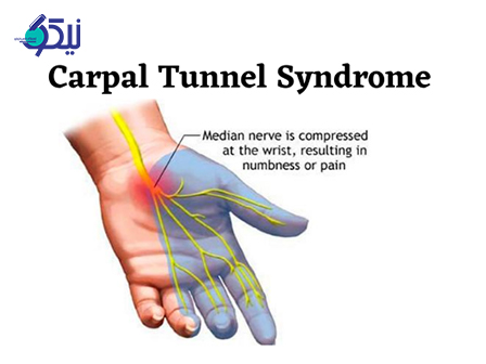 سندروم تونل کارپال چیست؟