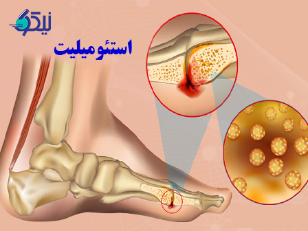 عفونت استخوان (استئومیلیت) چیست و چگونه درمان می شود؟