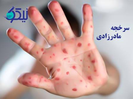 سندرم سرخجه مادرزادی (CRS): از علائم بالینی تا تشخیص آزمایشگاهی