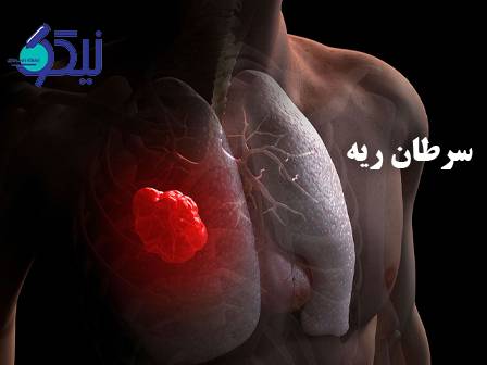سرطان ریه؛ قاتل خاموشی که دیر تشخیص داده میشودر