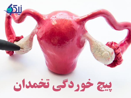 پیچ خوردگی تخمدان