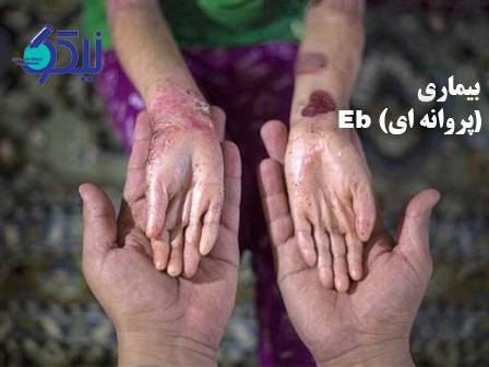 بیماری EB (پروانه‌ای) چیست؟