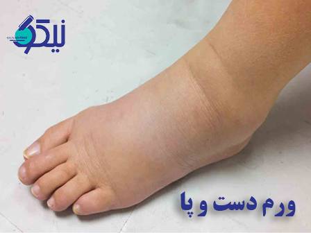 ورم دست و پا، لنفادم و راه‌های کنترل آن؛ از علل تا درمان‌های نوین