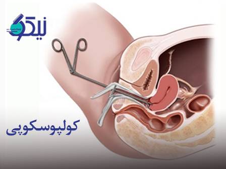 آشنایی با کولپوسکوپی چرا و چه زمان این آزمایش برای زنان حیاتی است؟