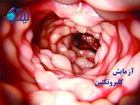 نقش آزمایش کلپروتکتین در تشخیص بیماری‌های التهابی روده