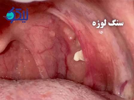 سنگ لوزه و بوی بد دهان؛ علت پنهان و راهکارهای پیشگیری