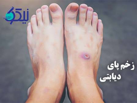 زخم پای دیابتی؛ تشخیص، درمان و پیشگیری