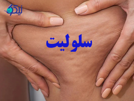 چگونه میتوان از شر سلولیت خلاص شد؟