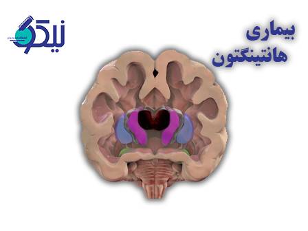 بیماری هانتینگتون؛ سفری دشوار در مسیر حرکت، حافظه و احساس